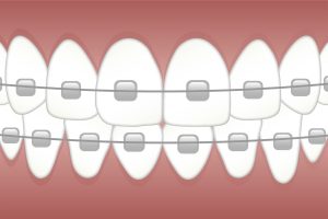 What Is The Cost Of Teeth Braces In Kenya