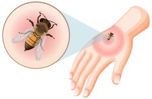 Bee bites sting on skin illustration