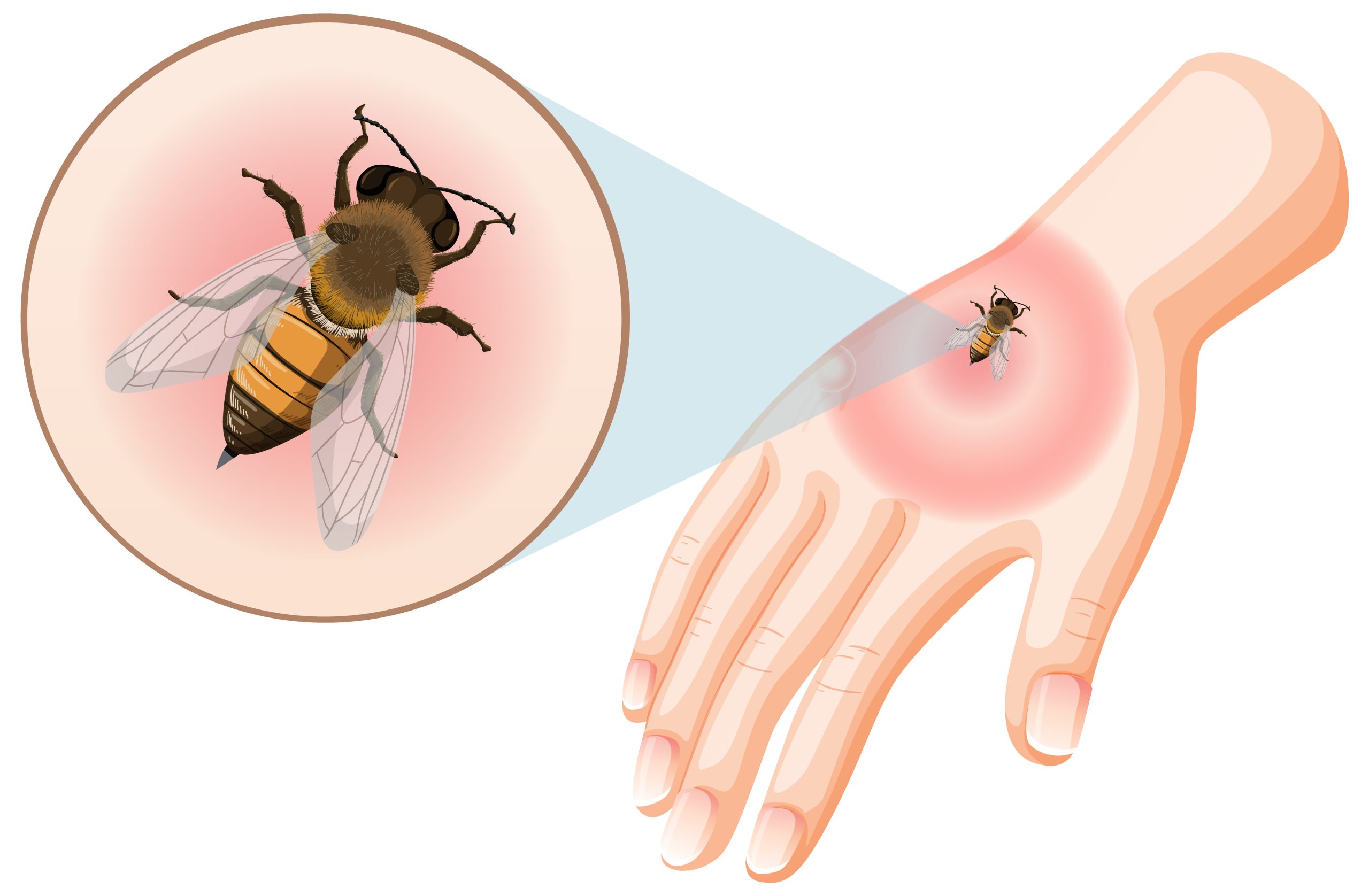 10 Best Antihistamine For Bee Sting